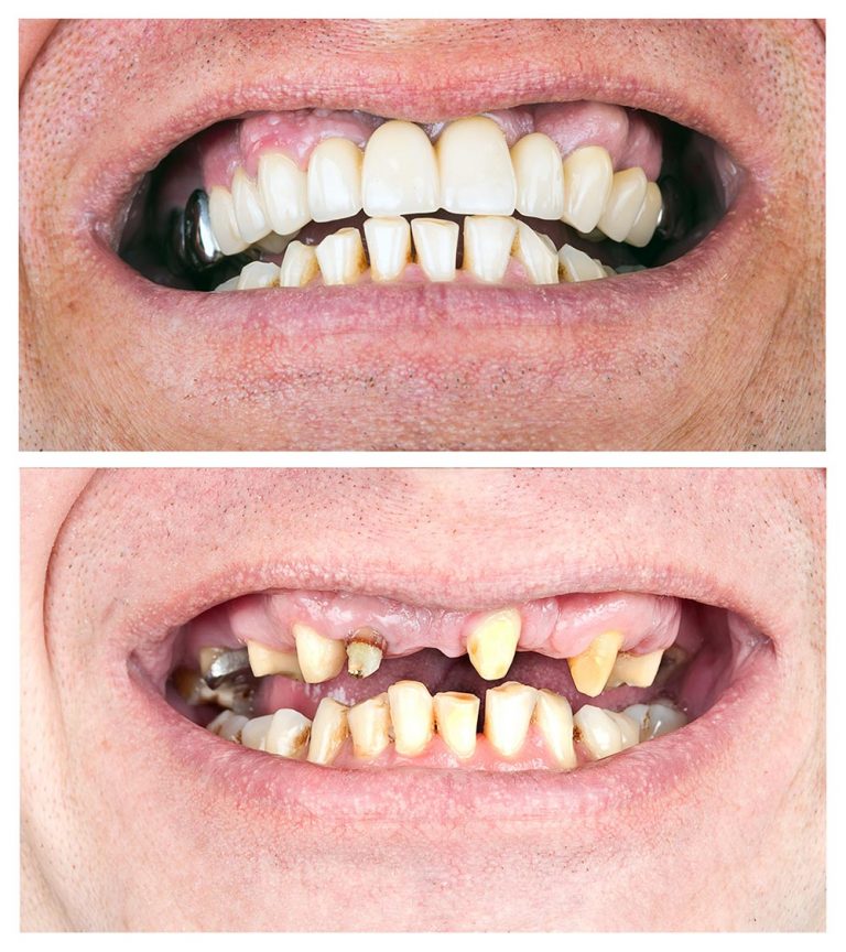 Dental Bridge - HOLLYWOOD SMILE DENTAL CENTER